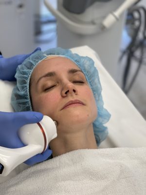 Dr. Morting hatte eine RF-Microneedling-Behandlung