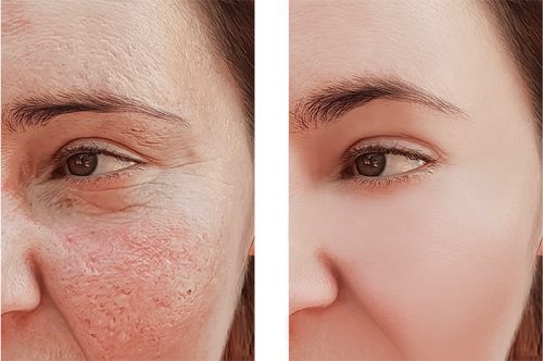 Was ist besser, chemisches Peeling oder Laser-Resurfacing?