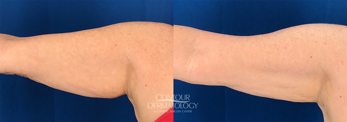 CoolSculpting for Arms, 2 Behandlungen