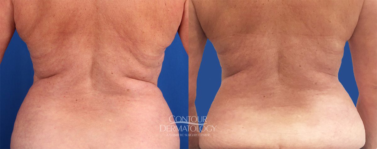 2 CoolSculpting-Behandlungen plus 4 VelaShape III-Behandlungen