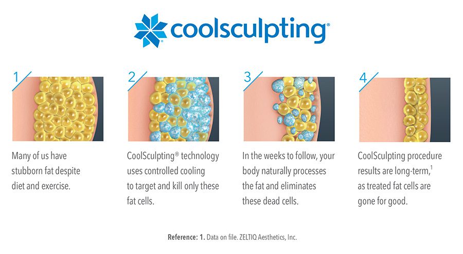 Wie CoolSculpting funktioniert, Schritt für Schritt.