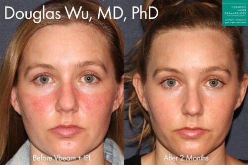 Kosmetische Laser-Dermatologie IPL-Behandlung zur Linderung der Symptome von Rosacea von Dr. Wu San Diego Ca