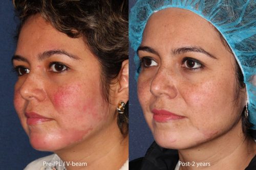 Kosmetische Laser-Dermatologie IPL-Behandlung zur Reduzierung von Rosacea-Rötungen von Dr. Wu San Diego Ca